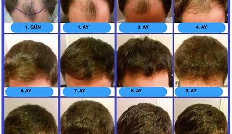 hair transplant growth chart