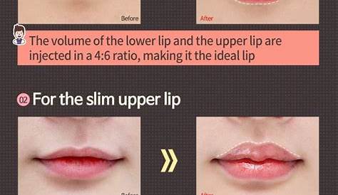 lip filler shapes chart
