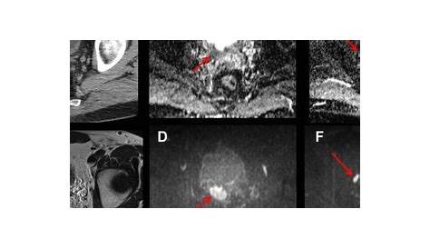 Large bladder tumor visualized by contrast enhanced computed tomography... | Download Scientific