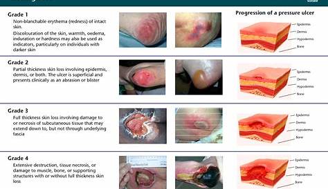 Pin by Redouan Salim on NPT | Wound care nursing, Pressure ulcer