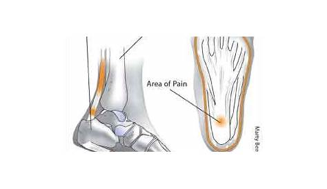 Heel Pain: Rx for Underfoot Agony - Arthritis Advisor