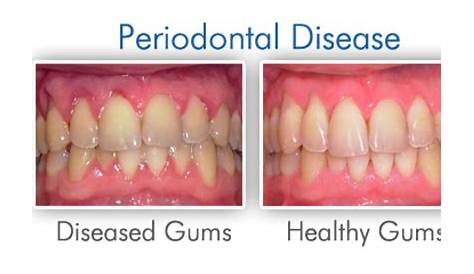 Gum Disease (Gingivitis & Periodontitis) Symptom and Treatment - Preston