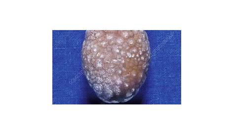 Gallstone - Stock Image - M165/0239 - Science Photo Library