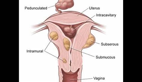 Uterine Fibroids Types and Treatments : Intramural, Submucosal and