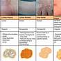 Vascular Skin Lesions Pictures