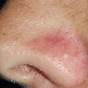 Vascular Lesions On Face