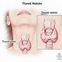 Thyroid Nodules Size Chart