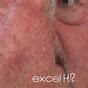 Vascular Lesions On Face