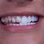 What Are Veneer Teeth