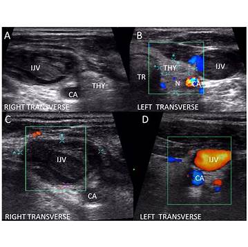 thyroid sonogram