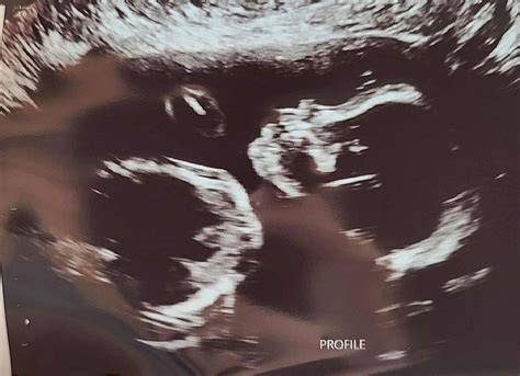 Do they look alike? | BabyCenter