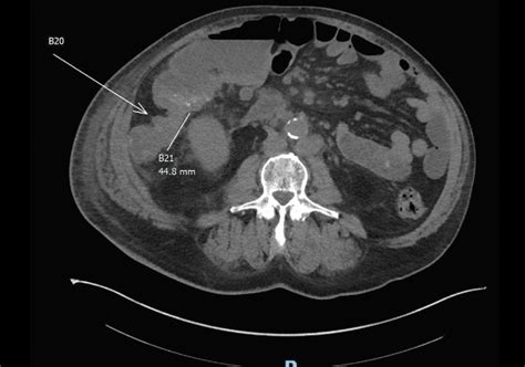 A Rare Case of Cutaneous Metastasis from Colon Cancer - Practical Gastro