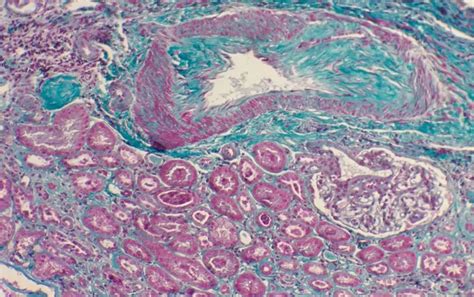 Spot the silent signs of kidney trouble early