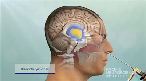 Intracranial Meningioma: Understanding the Most Common Type of Brain ...