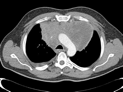 Figure 1 From Interim Petct In The Primary Mediastinal B Cell Lymphoma