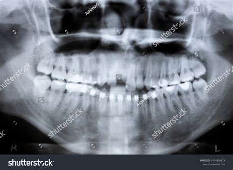 Стоковая фотография 1404810878 Dental Xray Photo Human Skull Teeth