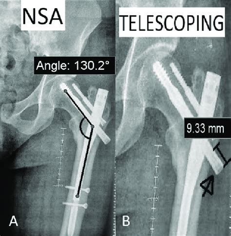 Assessment Of The Femoral Neck Shaft Angle Nsa And The Presence Of