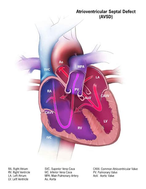 Atrioventricular Septal Defects Avsd Teachmepaediatrics