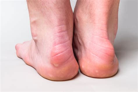 Haglunds Deformity Causes And Treatment My Footdr