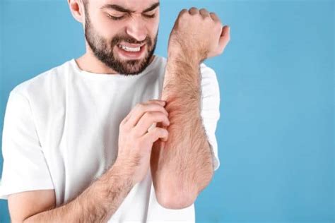 5 tips for managing eczema itch u s dermatology partners