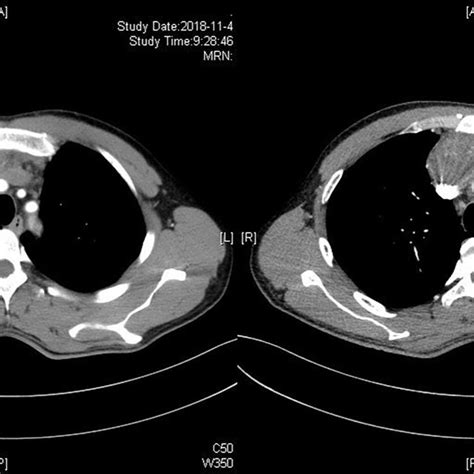 Perioperative Imaging Of Thymic Tumor A Dynamic Enhanced Ct Scan