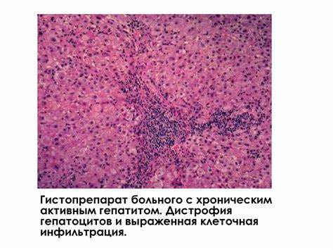 Гепатит цирроз печени диета Хронический гепатит. Цирроз печени - презентация онлайн Хронический гепатит. Цирроз печени - презентация онлайн Гепатит цирроз печени диета