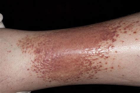 Eczema Rash On Legs Stop By My Blog About Eczema Only At