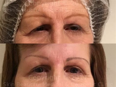 Cat Eye Pdo Thread Lift Before And After Eyes