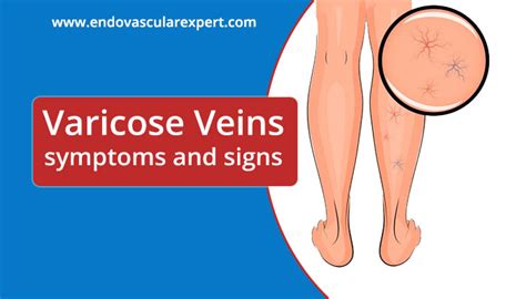 Varicose Veins Symptoms And Signs Dr Nikhil Bansal