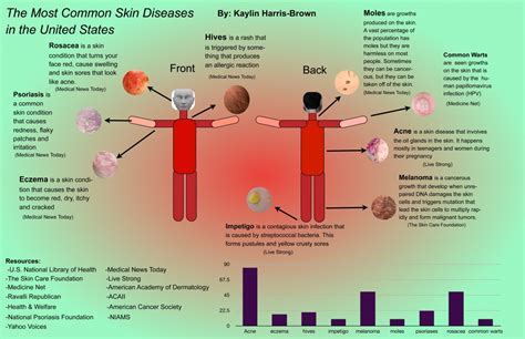Infographic The Most Common Skin Diseases In The Us Sli