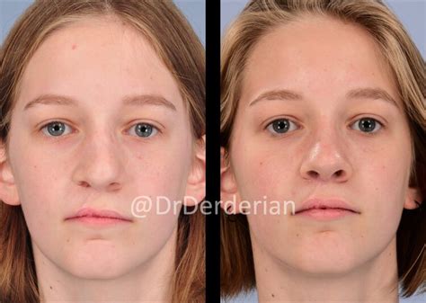 Cleft Rhinoplasty — Dr Derderian — Plastic And Reconstructive Surgery