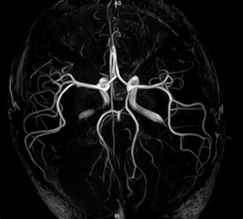 Magnetic Resonance Angiography Dubai Radiology Center Mri Scan