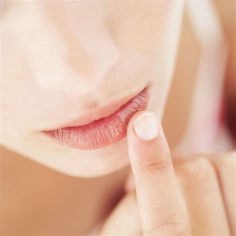 Chapped Lips Remedy How To Stop Chapped Lips