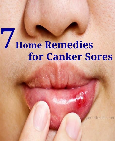 7 Home Remedies For Canker Sores Medi Tricks