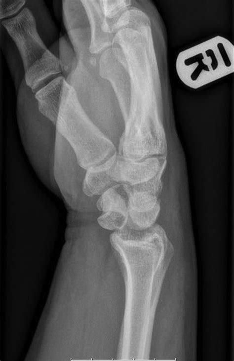 Radiological Signs Of A True Lunate Dislocation Tucker