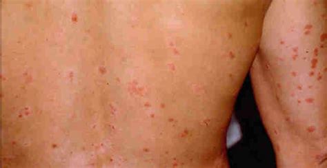 Guttate Psoriasis Why To Treat At Home 2018 Skincaremoz