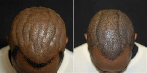 Scalp Surgery Corrects Cutis Verticis Gyrata Picture Medical Marvels