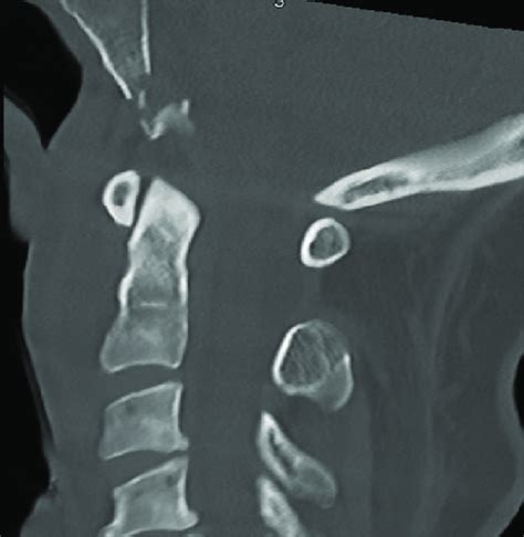 Computed Tomography Cervical Spine Mid Sagittal View Shows The