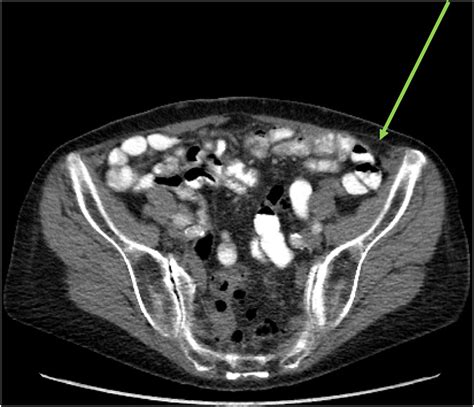 Ct Scan Axial View Showing The Spigelian Hernia Green Arrow