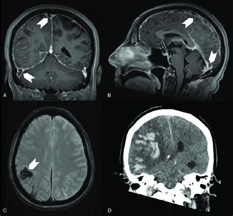 Patient Case 1 Cerebral Imaging Showing Cerebral Venous Thrombosis Download Scientific