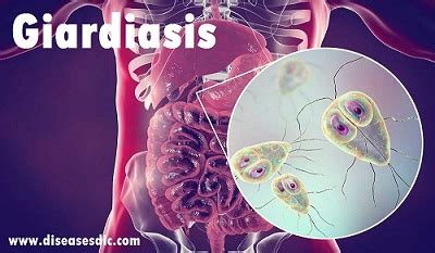 Giardiasis Causes Transmission Treatment And Prevention