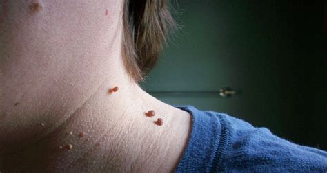 Por Qué Salen Las Verrugas En El Cuello Y Cómo Eliminarlas Skingroup