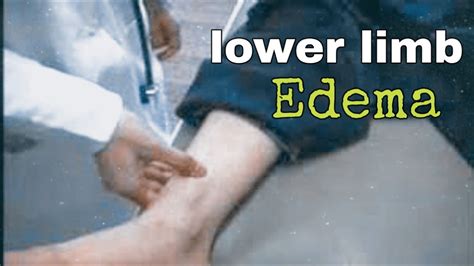 Lower Limb Edema Examination Youtube