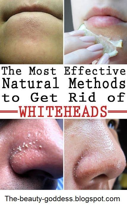 How To Get Rid Of Whiteheads Naturally Better Skin Whiteheads Remedy