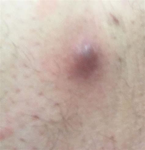 Many are born with a small hole at the cleft of their buttcrack. Any idea what this bump on my inner thigh might be ...