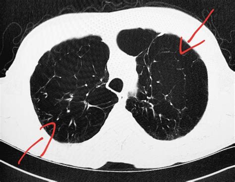 Chest Ct Severe Lung Damage Emphysema In A Long Time Smoker