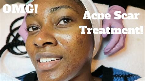 My Dermatology Acne Scar Treatment Microneedling Experience Youtube