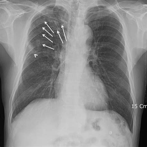 Chest X Ray Reveals Multiple Nodular Opacities In The Right Upper Lung