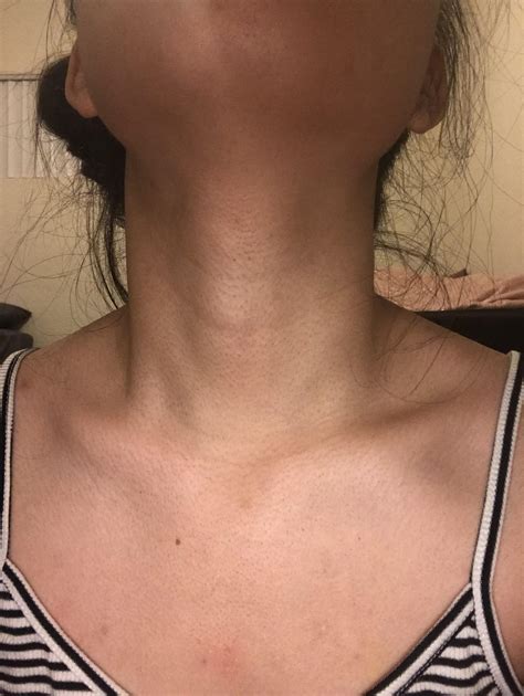 Skin Concern Need Help With Pores On Neckcollarbone Area It Looks