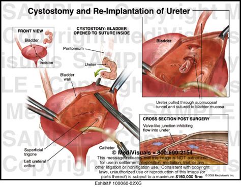 Cystostomy And Re Implantation Of Ureter Medical Exhibit